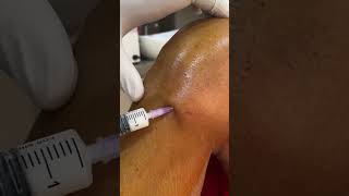 knee injection for pes anserinus bursitis #kneepain  #orthoderm #kneeosteoarthritis #steroids