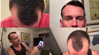 1 Year Using Hims for Hair Loss: Does It Really Work?