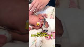 早产儿宝宝