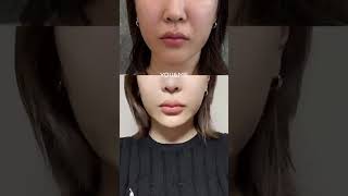 法令紋多與皮膚內細胞老化、膠原蛋白與彈性蛋白流失有關哦！