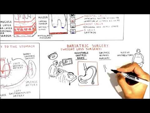 Weight loss surgery (types and problems)