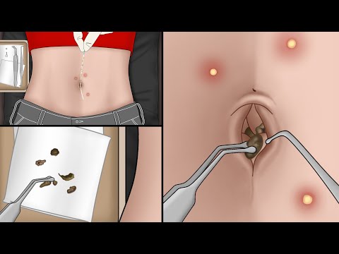 Is Your Belly Button Clean? ASMR Remove Navel Stone Animation | Meng's Stop Motion