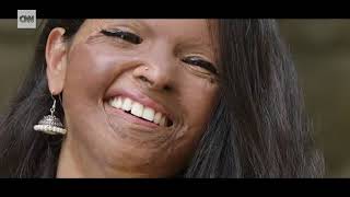 Laxmi Agarwal Refusing to hide her scars-India has one of the world's highest - acid attacks,
