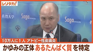アトピー性皮膚炎　かゆみの正体を解明　佐賀大学