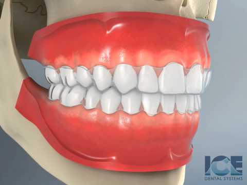 Invisalign