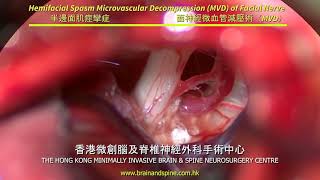 Hemifacial Spasm Microvascular Decompression of Facial Nerve