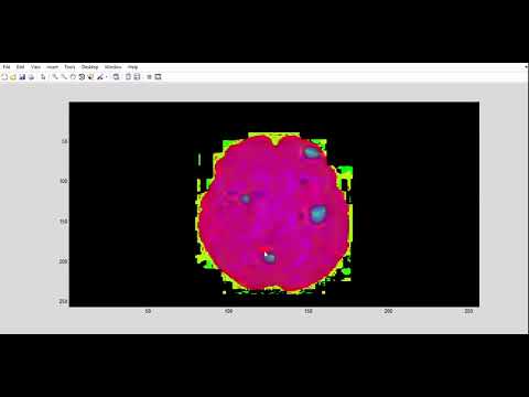 IDENTIFICATION AND DETECTION OF BRAIN TUMOUR SEGMENTATION USING FUZZY AND NEURAL NETWORK