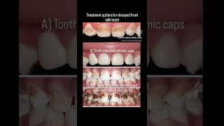 Treatment options for Decayed front milk teeth in kids. #pediatricdentist #kidsdentist #milkteeth