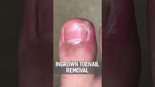 INGROWN TOENAIL REMOVAL! FULL VIDEO! #shorts #myfeetarekillingme