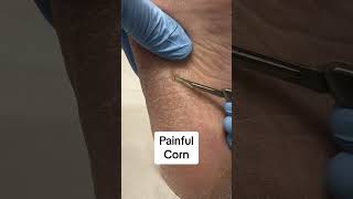 Say Goodbye to Painful Hard Corns: Effective Solutions Revealed! #FootCare #HealthyFeet