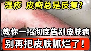 湿疹 皮癣总不好？皮肤又痒又难受！教你一招彻底告别皮肤病，别再把皮肤抓烂了！【中医养生】
