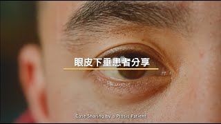 [醫生講場]  眼皮下垂 - 患者分享 (莊金隆醫生) Case Sharing by a Ptosis Patient (Dr Chong Kam Lung, Kelvin)