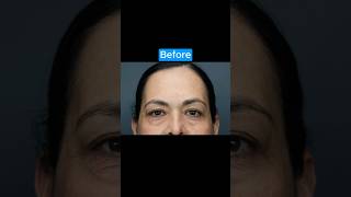 INCREDIBLE Natural Transformation #blepharoplasty