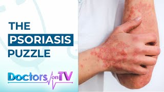 Psoriasis: Know the Symptoms, Causes, and available Treatments from Dermatology Specialist