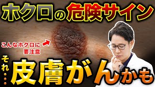 Do Not Ignore! The Features of Moles That Could Turn Into Skin Cancer