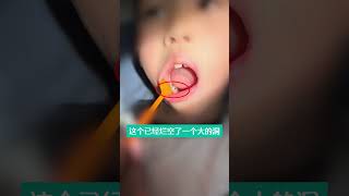 要重视刷牙，千万别蛀牙了蛀牙 牙科医生 医疗科普