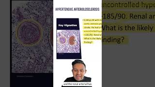 Hypertensive arteriolosclerosis for the USMLE | HyGuru