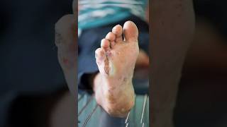 😲🦶🏻Diabetic Foot Care Tips | Prevention | Do's and Dont's | #shorts @FitterflyWellnessDTx