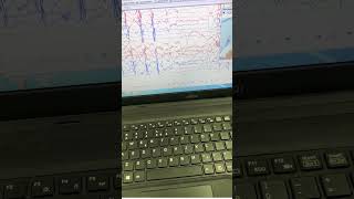 EEG Monitoring electroencephalogram #viral #eeg #yt #shortsvideo