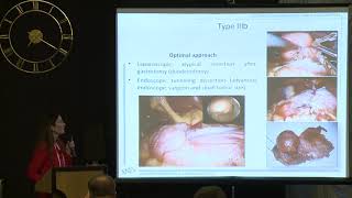 The Smart Approach to Surgical treatment of GISTs based on pre-operative EUS