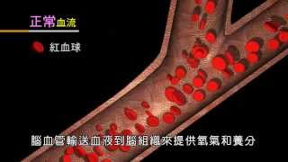 急性腦中風靜脈注射血栓溶解劑治療_rt_PA_衛教影片_國語版(高畫質)