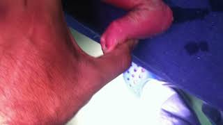 👶 𝟭-𝗠𝗼𝗻𝘁𝗵-𝗢𝗹𝗱 𝗕𝗮𝗯𝘆 𝘄𝗶𝘁𝗵 𝗖𝗹𝘂𝗯𝗳𝗼𝗼𝘁 (𝗖𝗧𝗘𝗩) 🦶  Clubfoot, or Congenital Ta