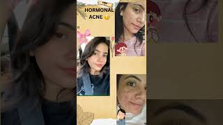 Vicious acne cycle 🥹 #skincare #acne #acnehelp #hormonalacne #shorts #cute