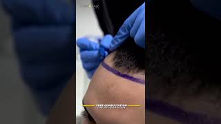 His Hair Transformation will Make You Rethink Hair Transplants! 2,500 grafts