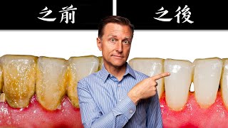 清除牙菌斑牙垢，简单自制牙膏 自然疗法,柏格医生dr berg
