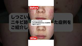 Cases where persistent acne and redness from acne scars were cured #shorts