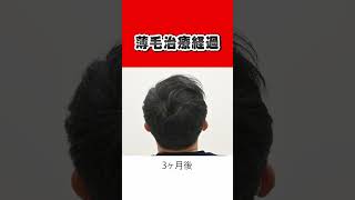 【AGA治療】薄毛治療の経過日記