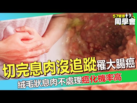 47歲病人「切完息肉沒追蹤」慘罹三期大腸癌！絨毛狀息肉不處理「癌化機率高」醫師嘆：長在右邊難發現！【 @57healthy  】#田知學 醫師