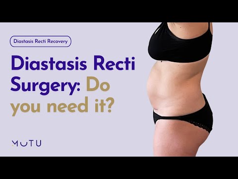 Diastasis Recti Surgery: Is It The Right Choice or You?