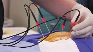 Radiofrequency Ablation (RFA)