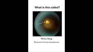 Rings in Ophthalmology! #neetpgrevision #free #onlinelectures #medicalstudent #dnb #mbbs