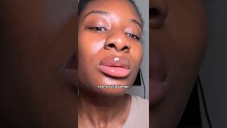 Before + After lip plumper👄 #lipplumper #plumpinglipgloss #lipplump #lipfiller #fulllips