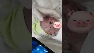 早产儿检查眼睛