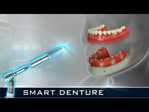 SMART implant-supported Denture (Full Mouth) l Curveia Dental Animation