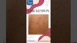Chickenpox - Best homeopathy treatment Drkukreja kalani online consult8291492566