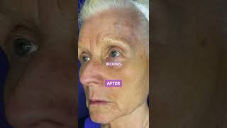 Scarlet SRF for Fine Lines, Scars, and Radiant Skin