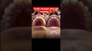 Does mewing straighten your teeth? *YES*