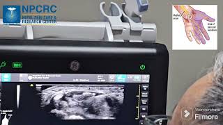 Carpel Tunnel Syndrome and Non Surgical Treatment
