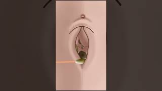 ASMR Huge navel stone removal animation #shorts #asmr #viral