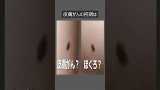 体にこんな「ほくろ」があったら「皮膚がん」です（今すぐ確認してください）
