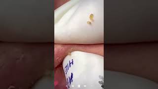 Skincare | Blackheads Removal #519 #tweezers skincare #blackheads blackheads