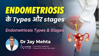 Endometriosis के Types और Types को समझें | Endometriosis Types & Stages Dr Jay Mehta: Shree #ivf