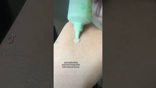 A primer for acne scars? Let’s see if it works! #acne #topicals #primer #acnescars #makeupforacne