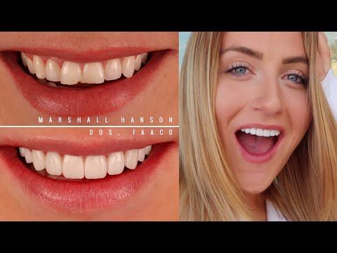 I GOT VENEERS!