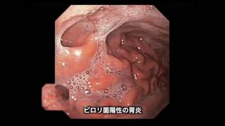ピロリ菌　「消化器内科　横浜むらきクリニック」