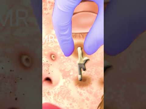 Cyst Explosion | Severe Acne Removal | Pimple Popping #satisfyingasmr  #asmranimationvideo